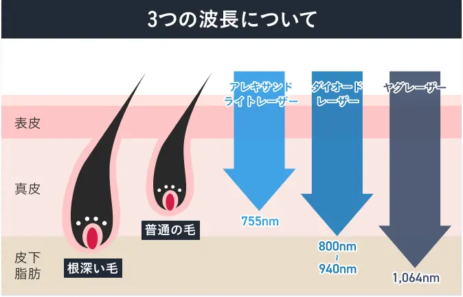 3種類のレーザー波長(アレキサンドライト、ダイオード、YAG)の図解