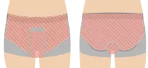 VIO脱毛