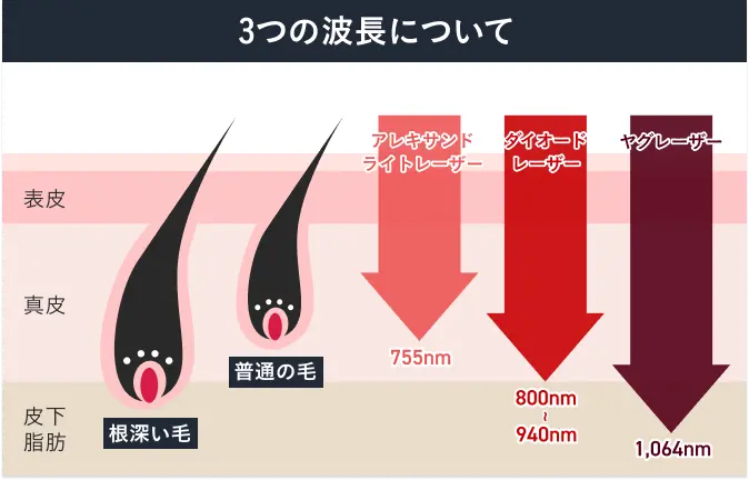 3種類のレーザー波長(アレキサンドライト、ダイオード、YAG)の図解