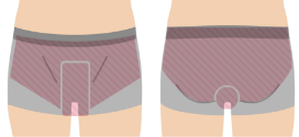 VIO脱毛のパーツ