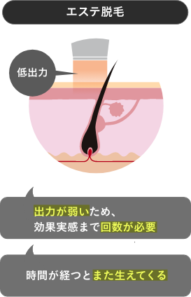 エステ脱毛の特徴