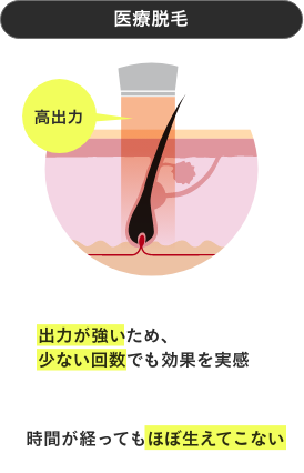 医療脱毛の特徴