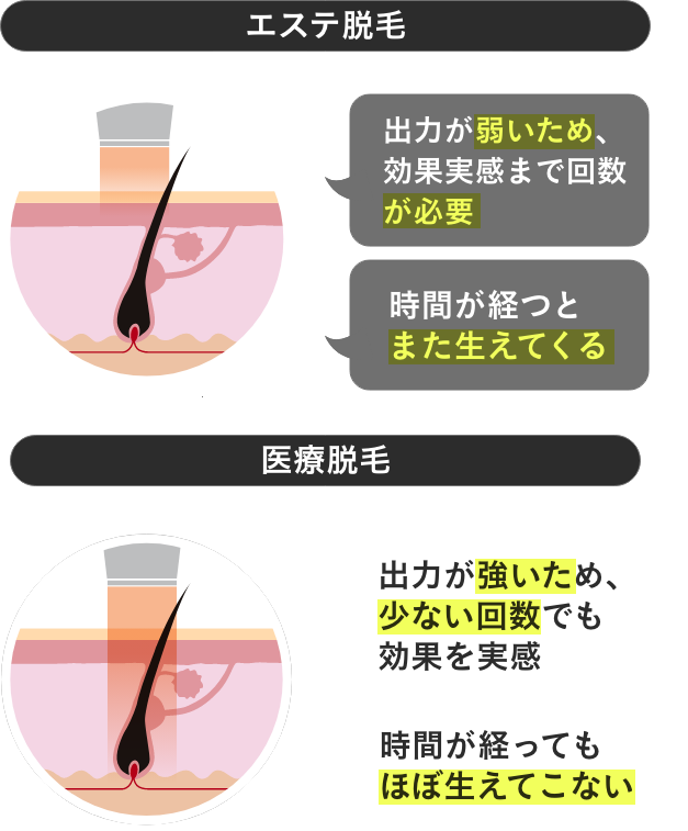 エステ脱毛と医療脱毛の特徴