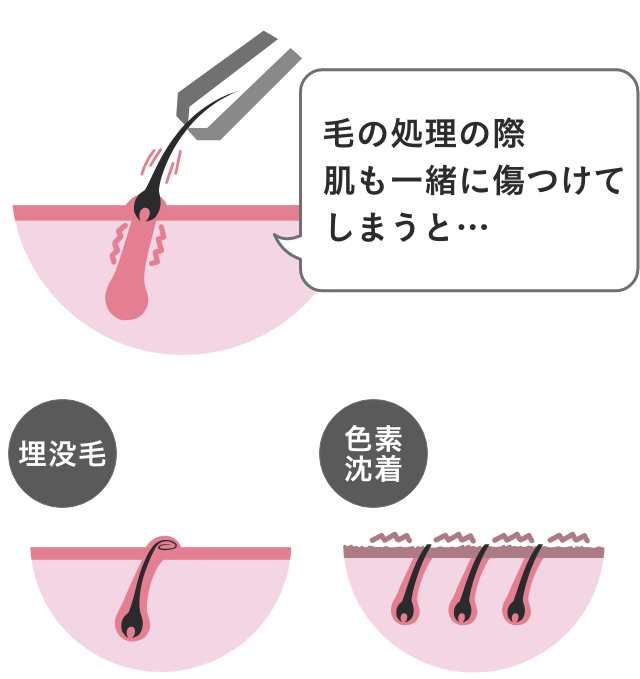 毛の自己処理のリスク