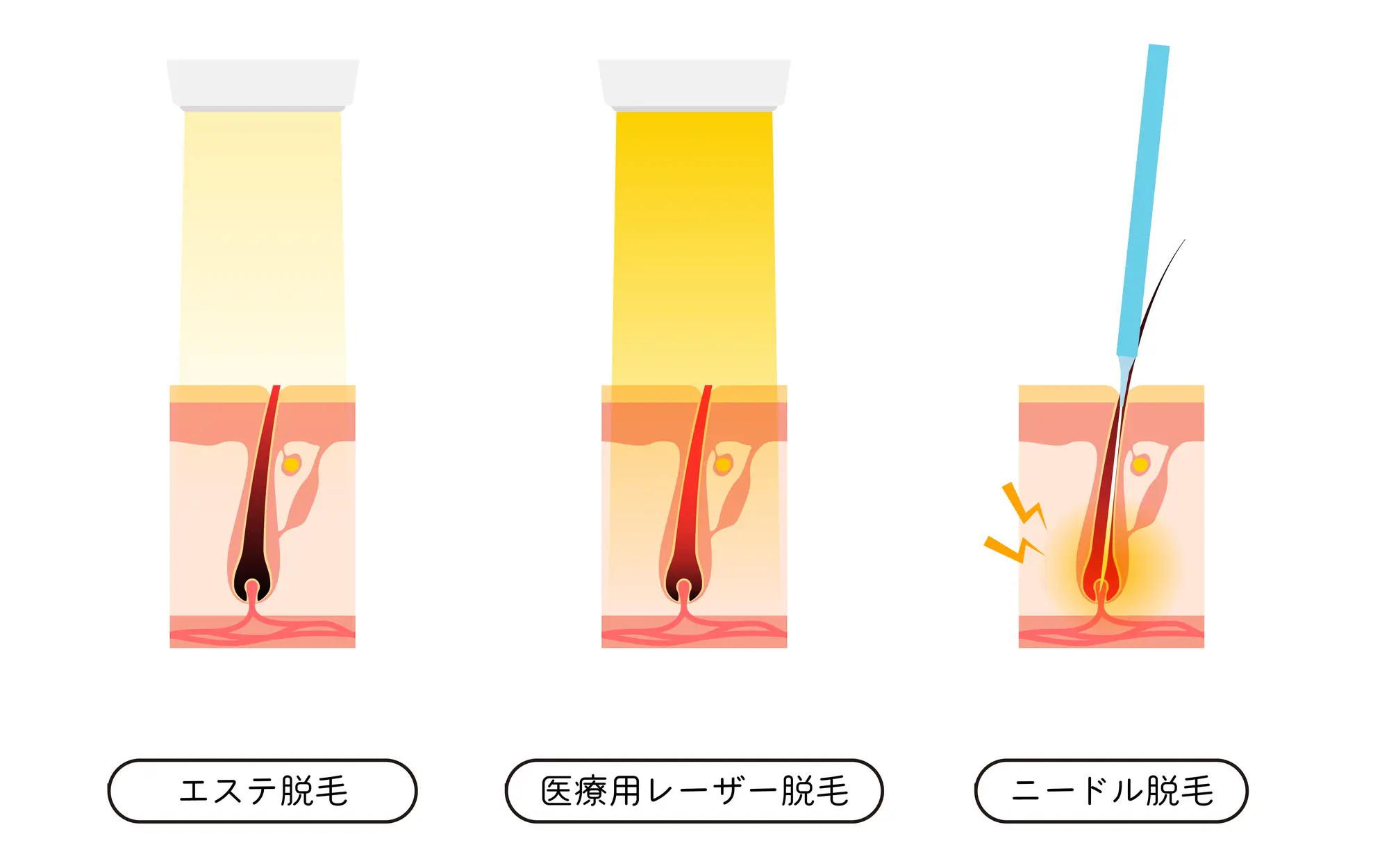 レーザー脱毛との違い