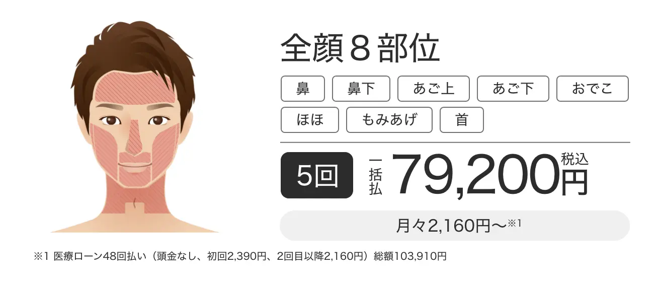 ヒゲ脱毛・顔脱毛 全体8部位 5回一括払 税込79,200円